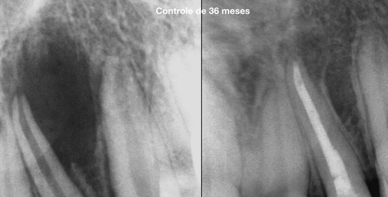 Endodontia em sessão única ou múltipla