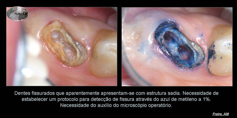 Tratamentos Ângelo Freire Endodontia Microscópica