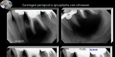 Curetagem Periapical e Apicoplastia com Ultrasson 