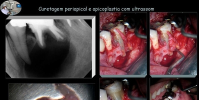 Curetagem Periapical e Apicoplastia com Ultrasson